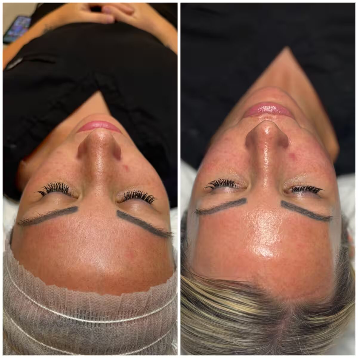 Before and after comparison showing skin improvement from treatment