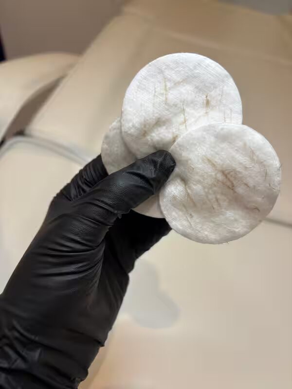 Dermaplaning result — cotton pads showing removed dead skin and peach fuzz
